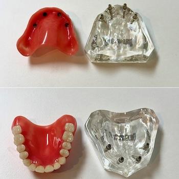 Dental implants in Seminole